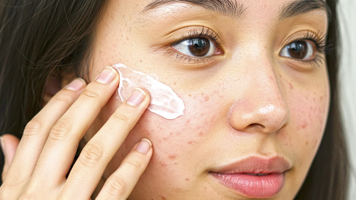 Acne Dermatologist Appointment Near Alexandria, Virginia